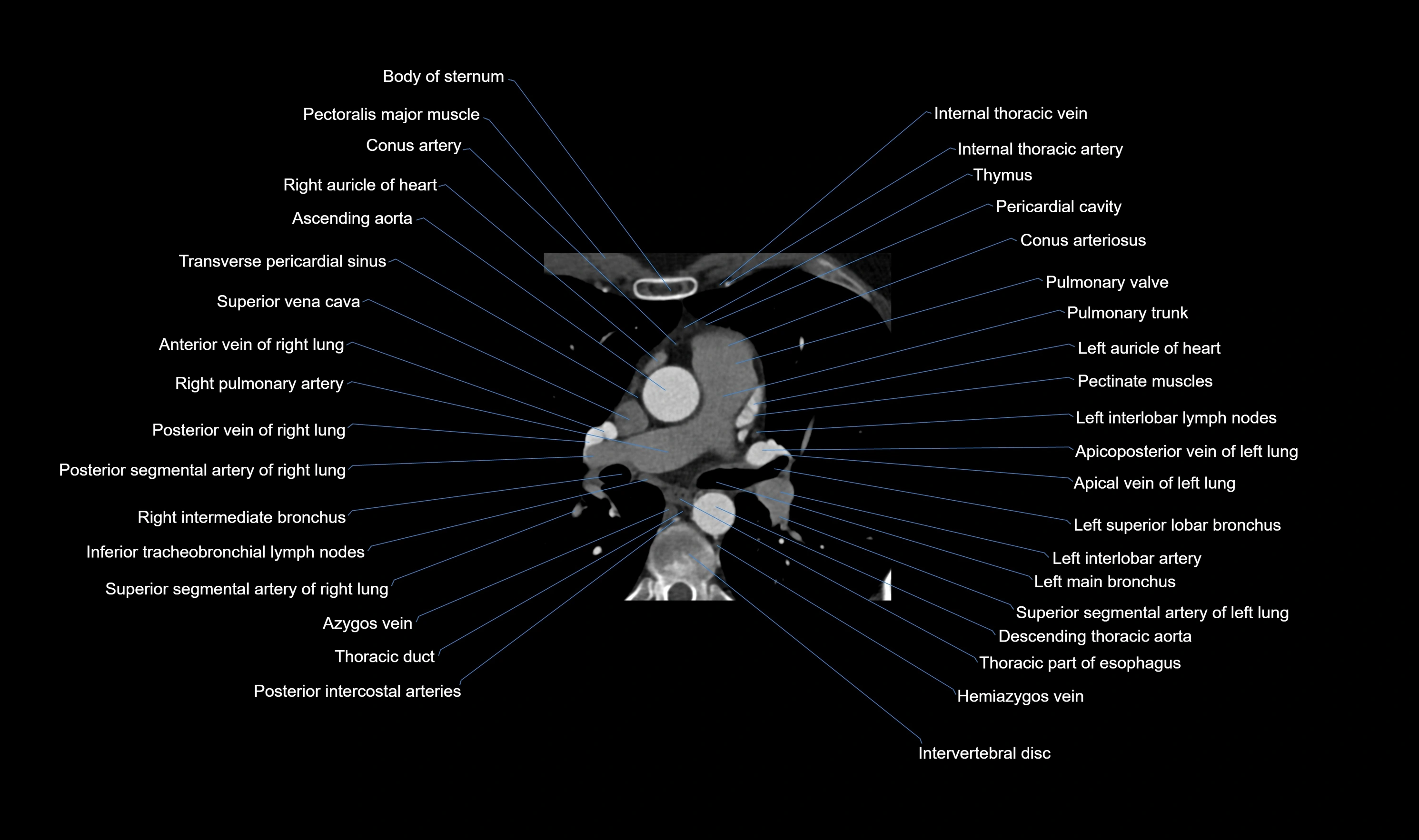 CT heart (coronary angiogram) axial view cross sectional anatomy labelled radiology image-00016.webp
